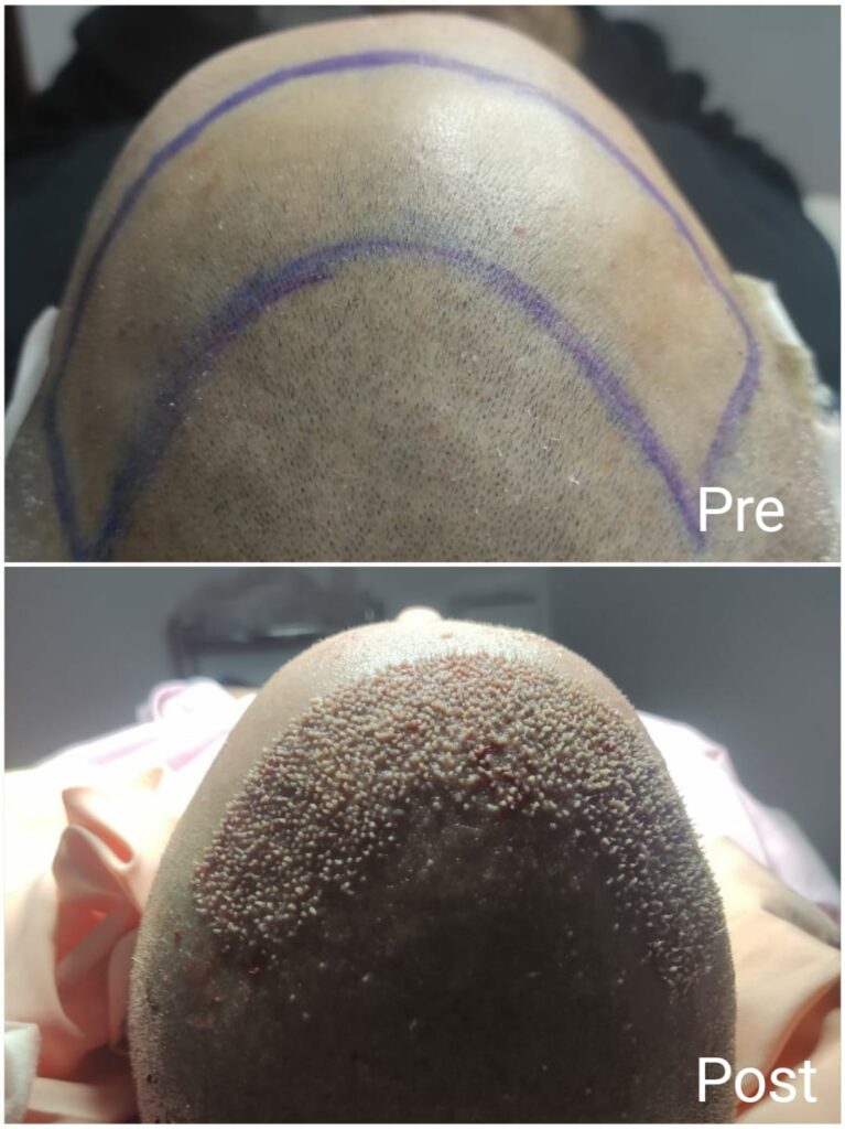 Hair transplantation using Regenera technique before and after
